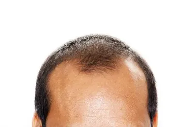 Male Pattern Hair Loss Treatment in HCM City