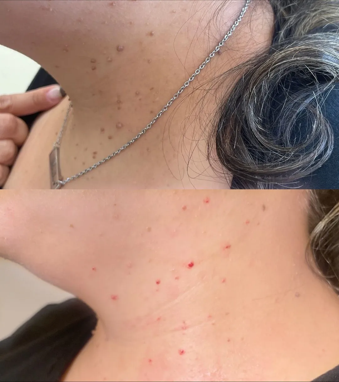 Mole Removal in Ho Chi Minh City