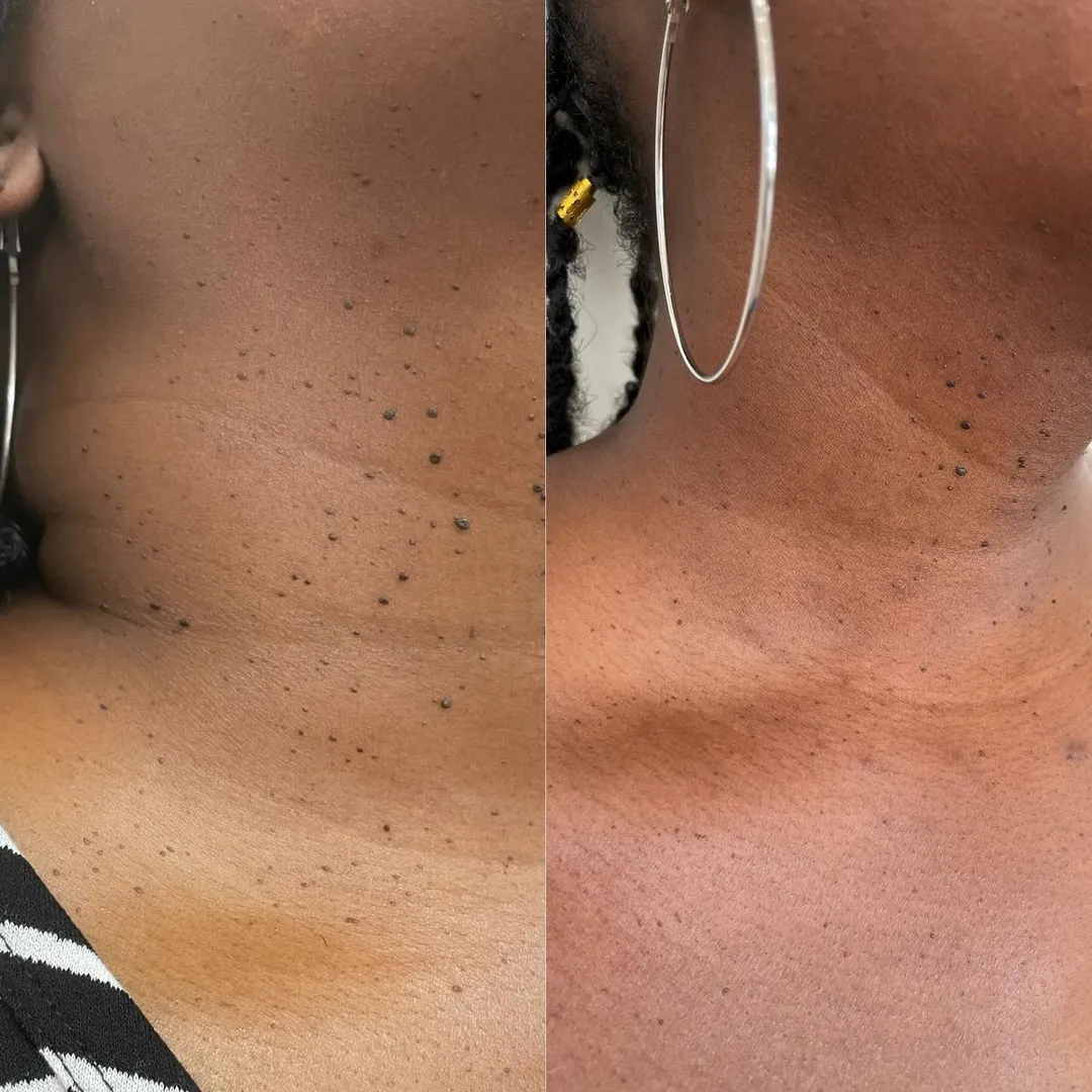 Mole Removal in Ho Chi Minh City