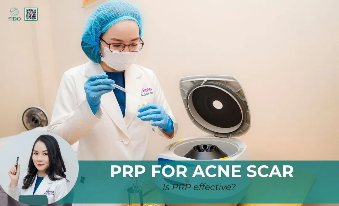 Is PRP effective for acne scars?