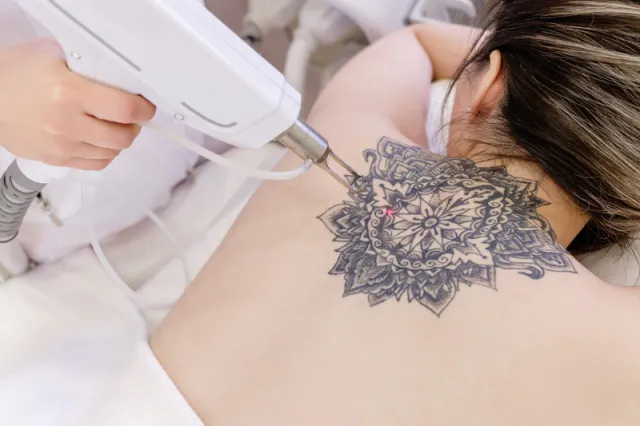 Xóa Hình Xăm Bằng Laser Tại TP.HCM