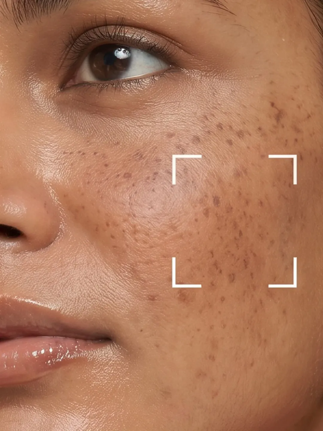 Melasma Treatment in HCM City