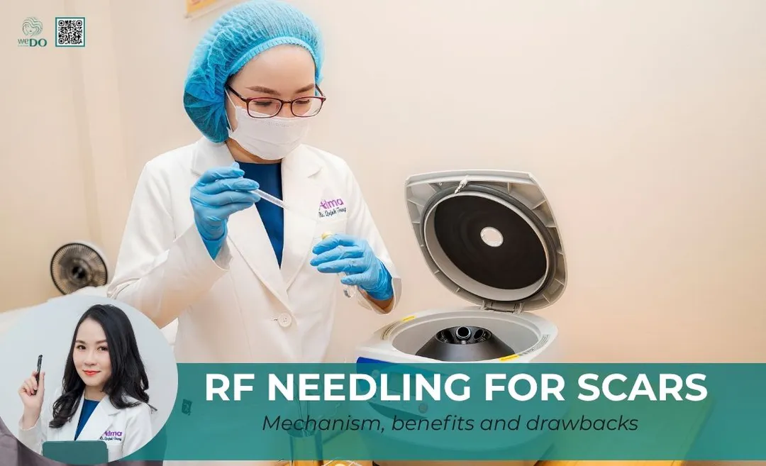 PRP trị sẹo có hiệu quả không?