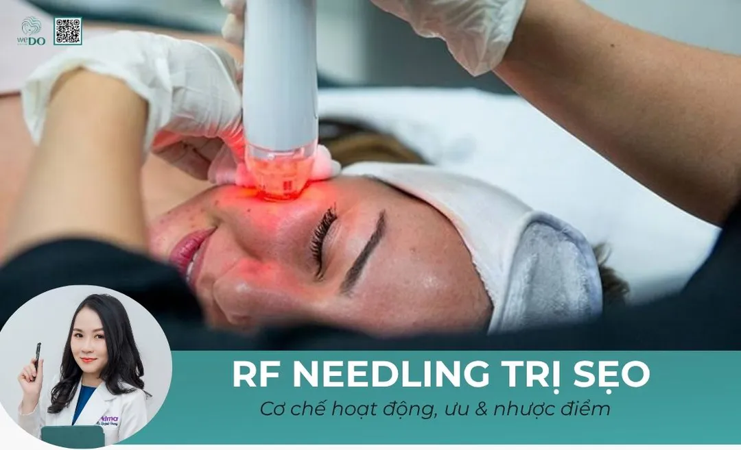 RF Needling trị sẹo là gì? Cơ chế, tác dụng, ưu và nhược điểm