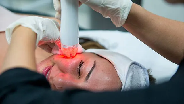 rf needling trị sẹo