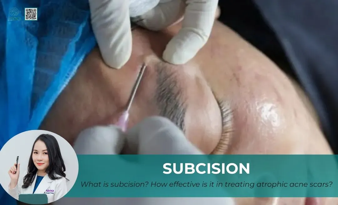 What is subcision? How effective is it in treating atrophic acne scars?