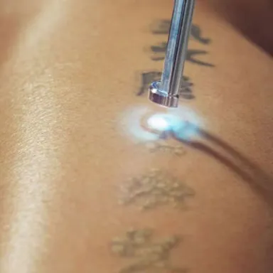 Laser Tattoo Removal in Ho Chi Minh City