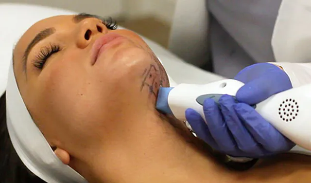Thermage Trẻ Hóa Da Tại HCM