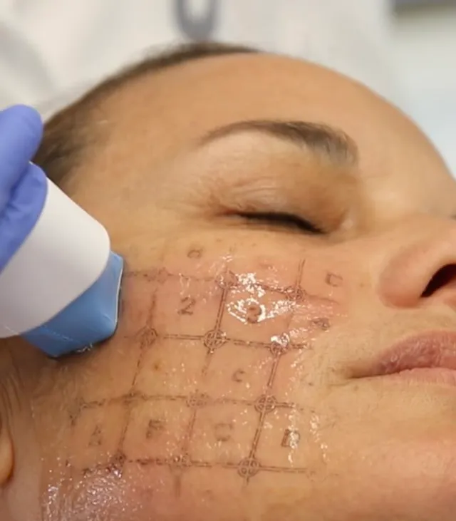 Thermage Trẻ Hóa Da Tại HCM