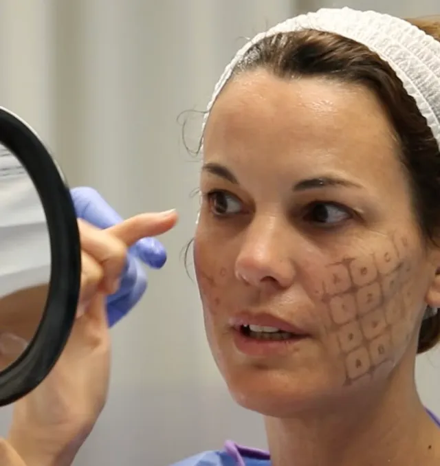 Thermage Trẻ Hóa Da Tại HCM