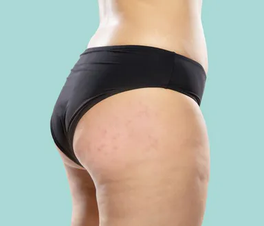 Mụn Thâm Ở Mông: Cách Điều Trị Mụn Mông Và Thâm Mông Hiệu Quả