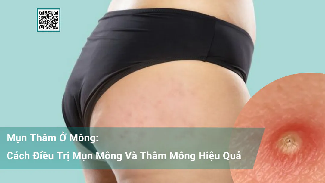 Mụn Thâm Ở Mông: Cách Điều Trị Mụn Mông Và Thâm Mông Hiệu Quả