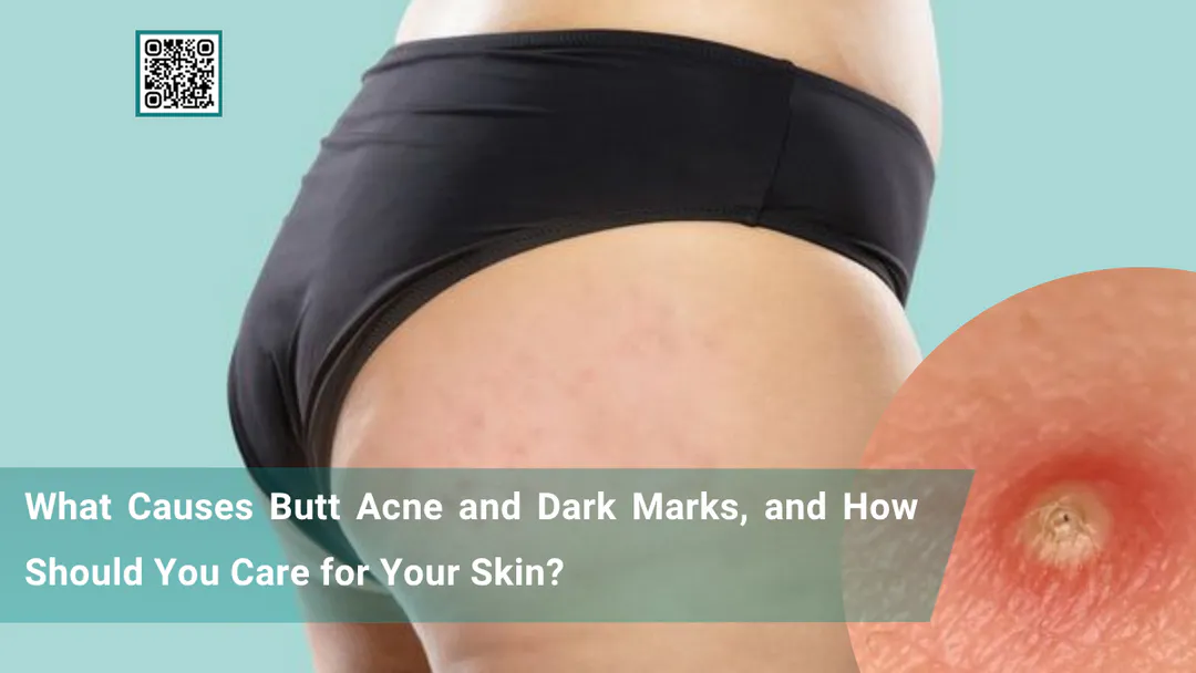What Causes Butt Acne and Dark Marks, and How Should You Care for Your Skin?