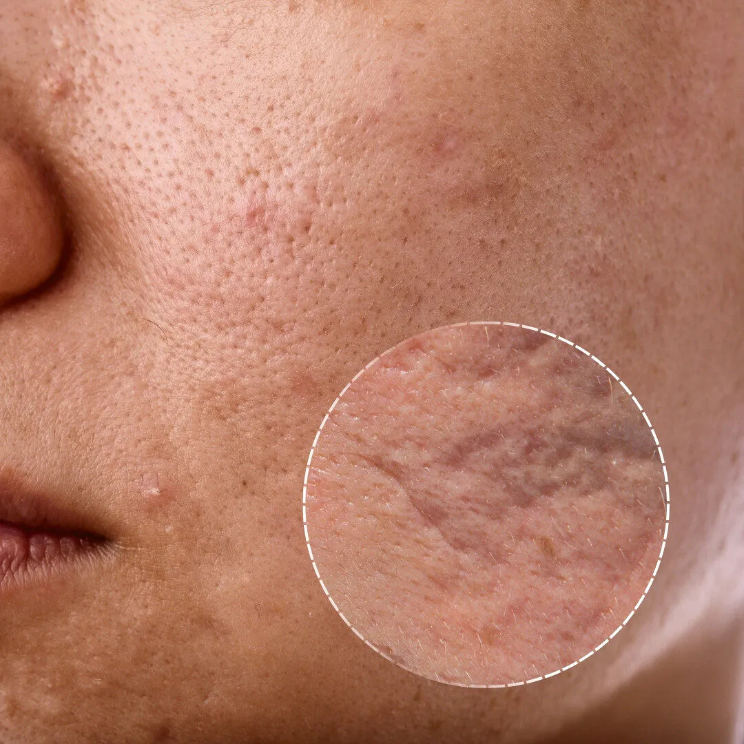 Pitted Scars on the Nose: How to Distinguish Them from Enlarged Pores