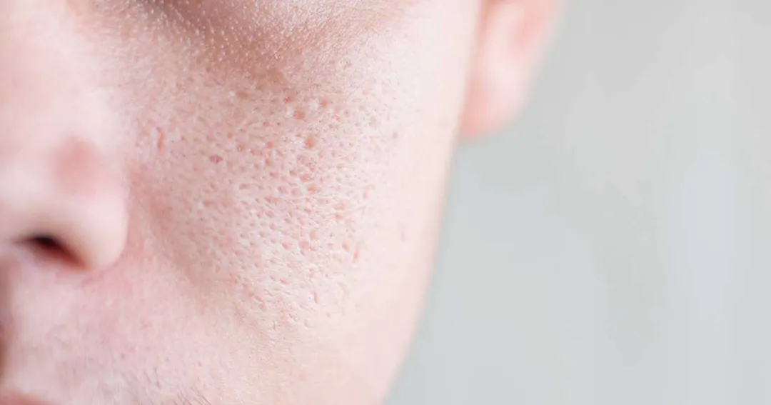 Sẹo rỗ ở mũi và cách phân biệt với lỗ chân lông to