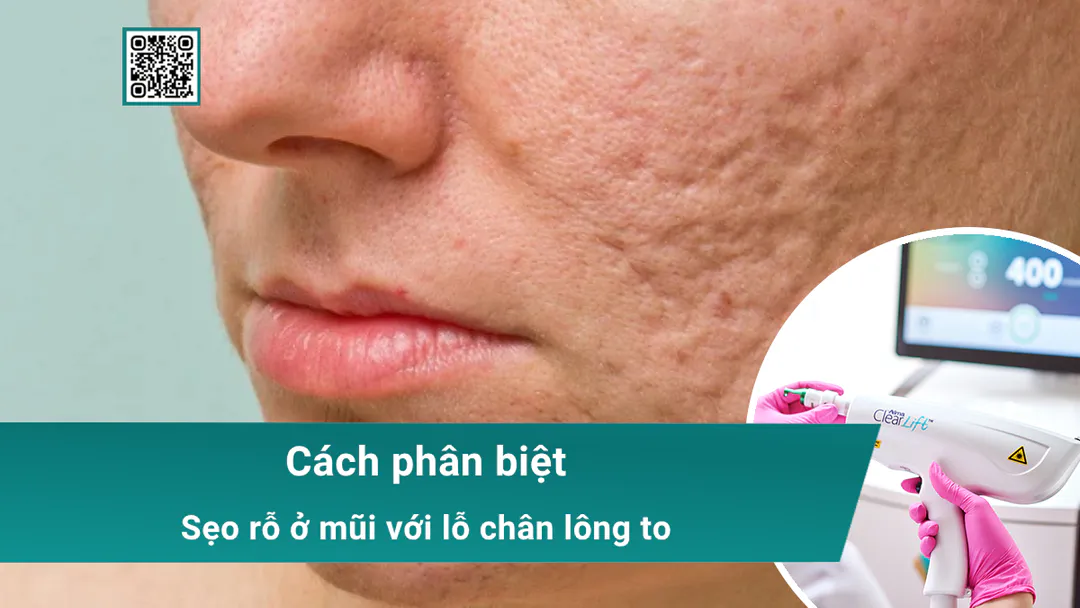 Sẹo rỗ ở mũi và cách phân biệt với lỗ chân lông to