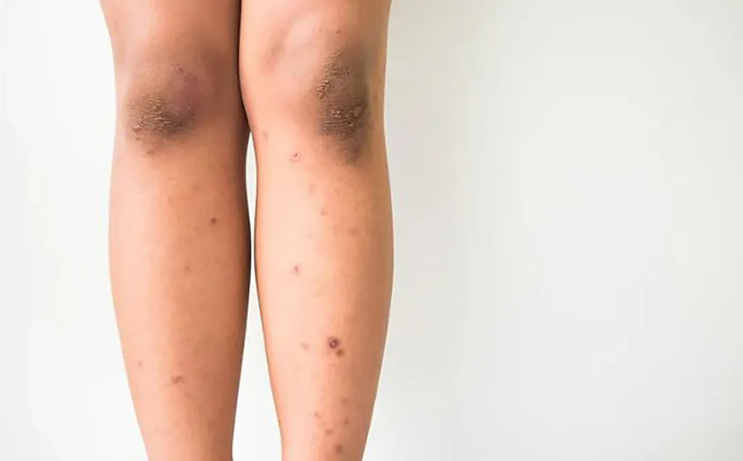 Long-Standing Dark Scars on the Legs