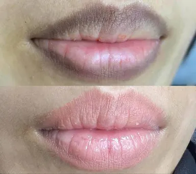 Thâm mép môi do đâu và cách cải thiện phù hợp