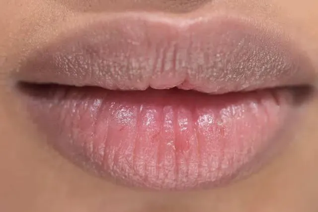 What Causes Dark Corners of the Mouth and How Can They Be Improved?