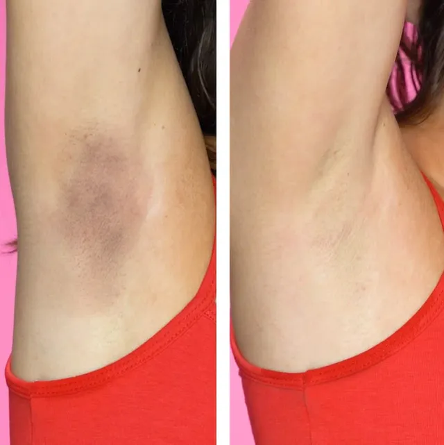 Trị thâm nách: Nguyên nhân và cách cải thiện