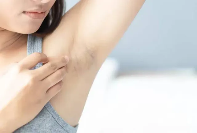 Underarm Darkening