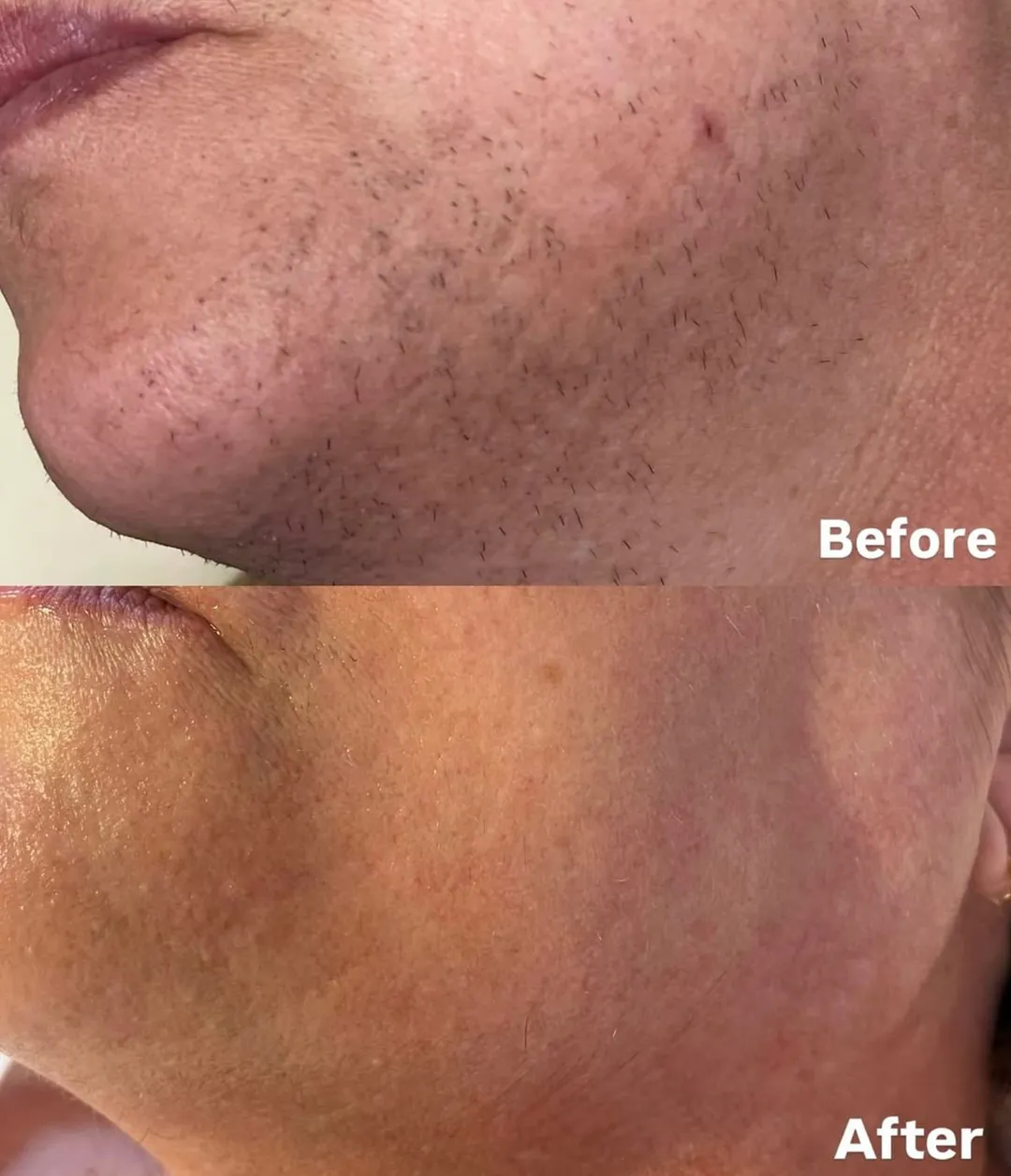Is Laser Facial Hair Removal Right for You?