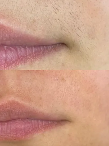 Triệt lông mặt bằng laser có phù hợp với bạn không