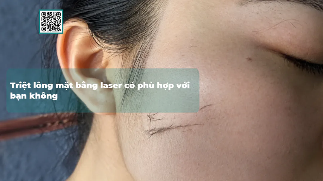Triệt lông mặt bằng laser có phù hợp với bạn không
