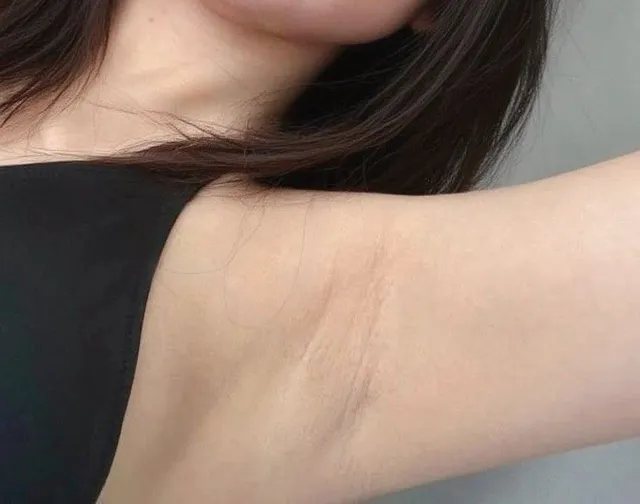 Triệt lông nách bao nhiêu lần và vì sao mỗi người khác nhau
