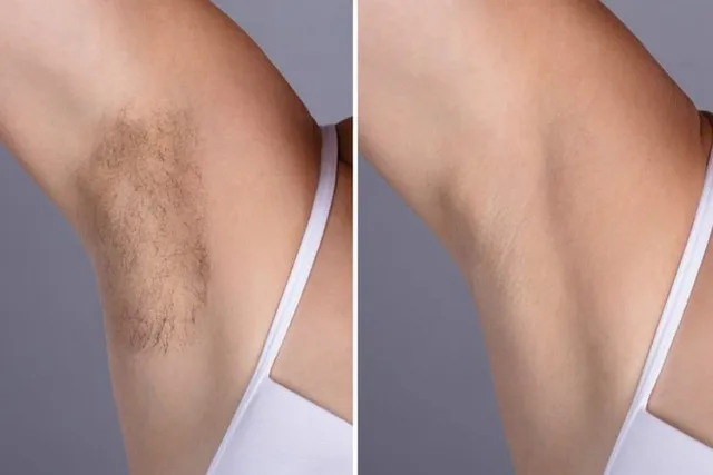 Underarm Hair Removal