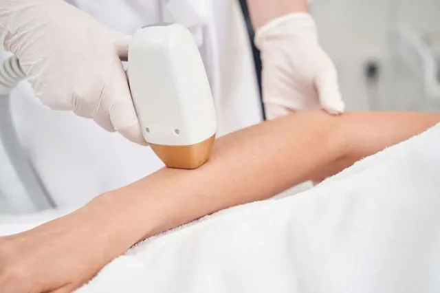 Triệt lông tay bằng laser và những điều nên biết trước khi làm