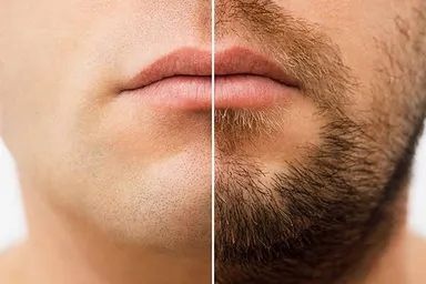 Beard hair removal for men