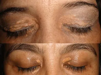 Eyelid Xanthelasma: What to Know Before Treatment