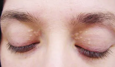 U vàng mi mắt và những điều cần biết trước khi điều trị