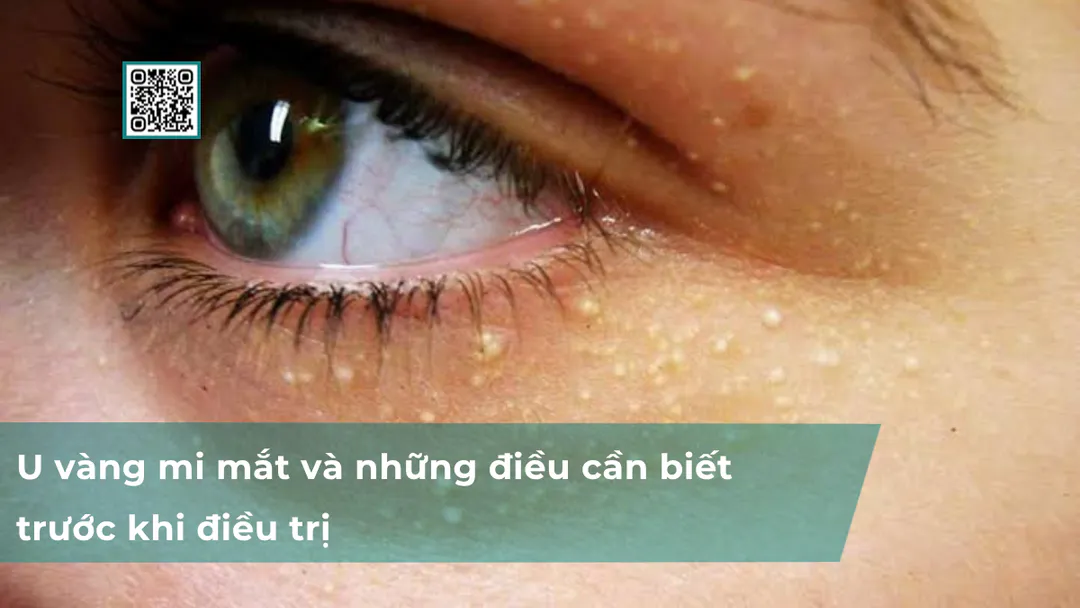 U vàng mi mắt và những điều cần biết trước khi điều trị