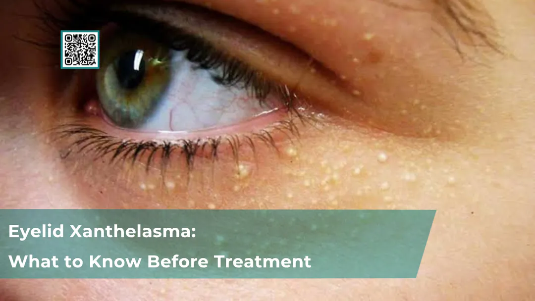 Eyelid Xanthelasma: What to Know Before Treatment