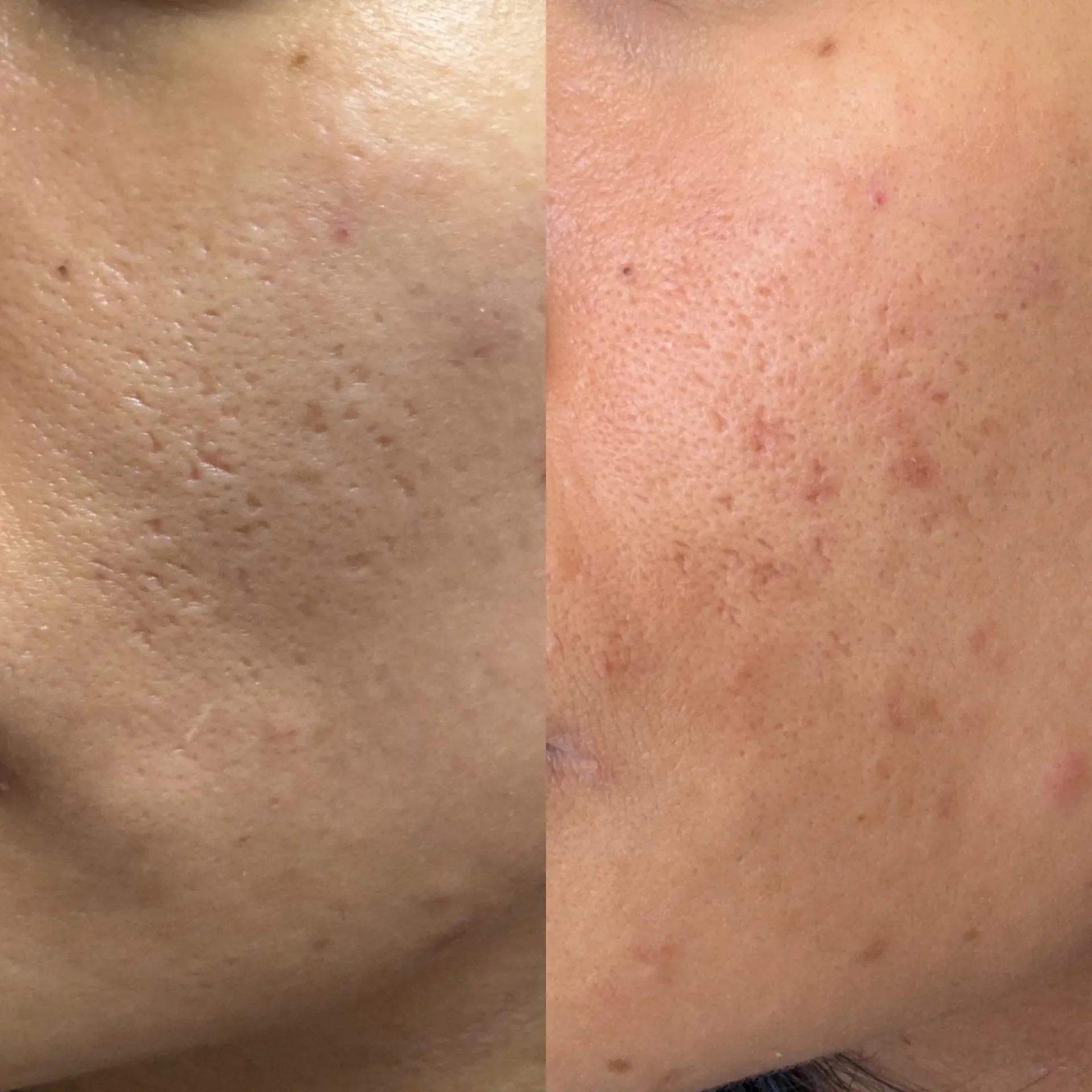 Pitted Scars on the Nose: How to Distinguish Them from Enlarged Pores